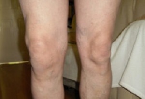 εκδηλώσεις αρθρώσεων της άρθρωσης του γόνατος (1)
