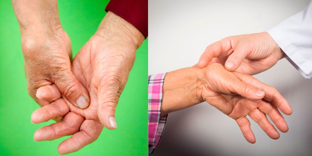 πρήξιμο και πόνους είναι τα πρώτα σημάδια αρθρίτιδας των χεριών