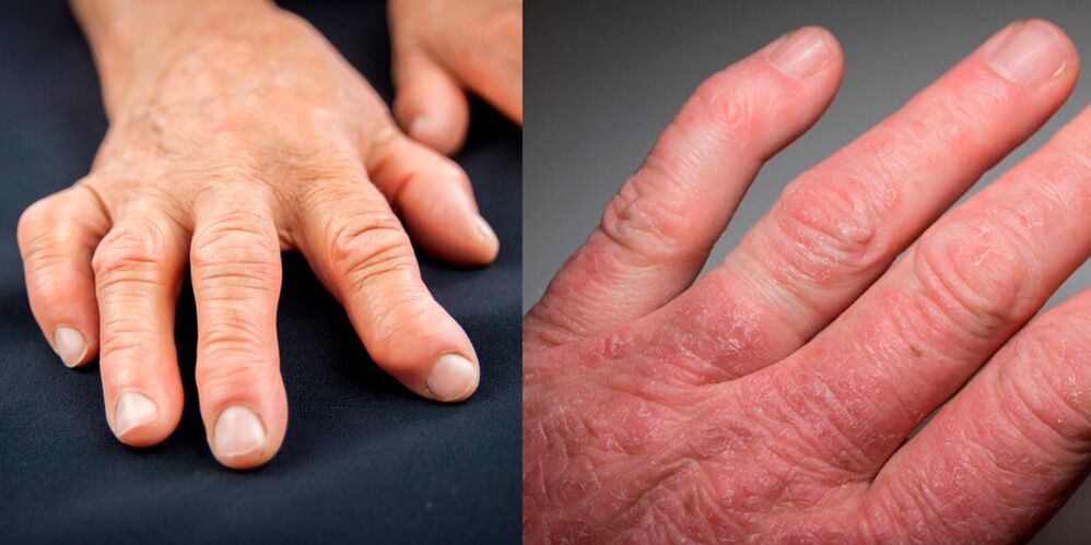 ρευματοειδής και ψωριασική αρθρίτιδα των χεριών