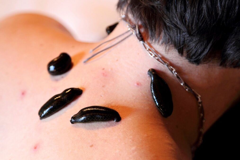 βδέλλες για αυχενική οστεοχονδρωσία